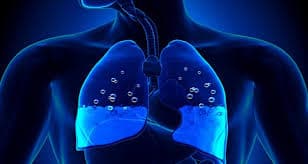 آب آوردن ریه (پلورال افیوژن )