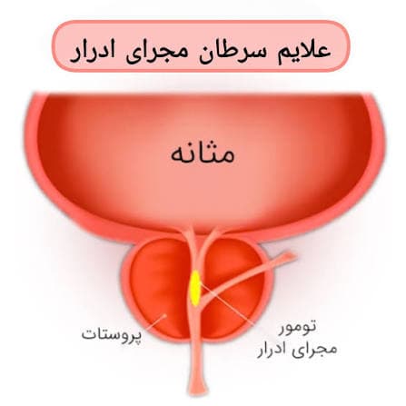 تومور مثانه (فایل صوتی)