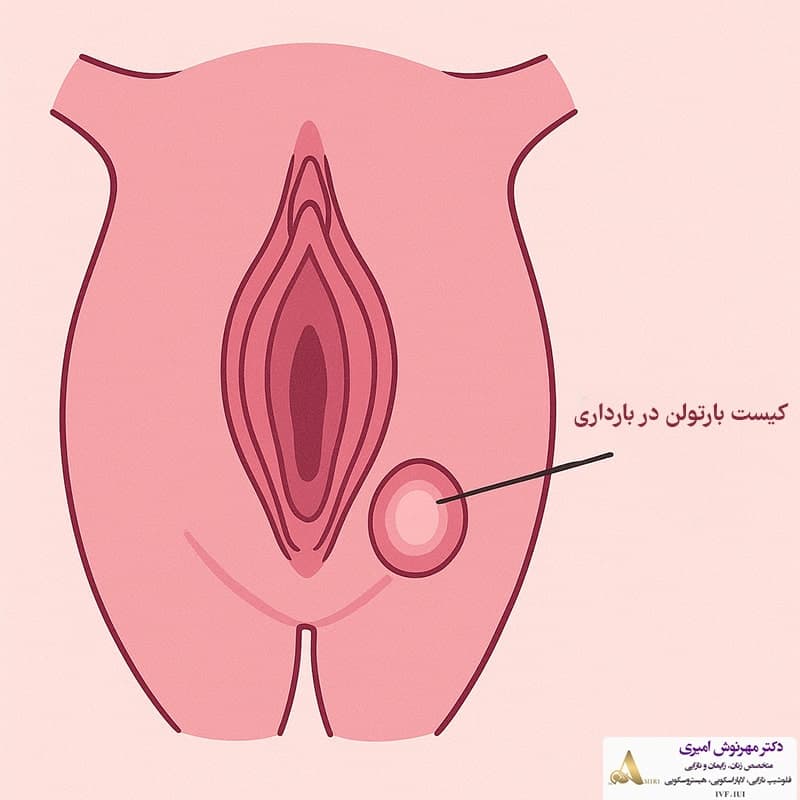 غده در دهانه واژن (کیست بارتولن) - فایل صوتی